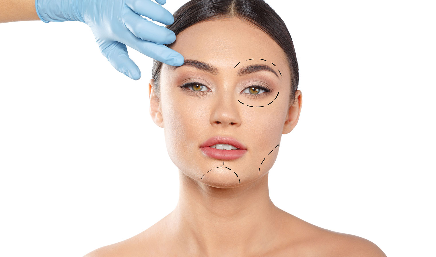 blepharoplasty